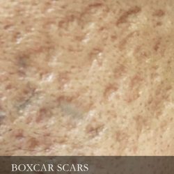 Boxcar Scars