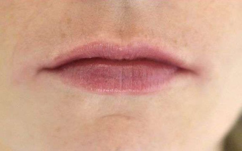 Thin Upper and Full Lower Lips
